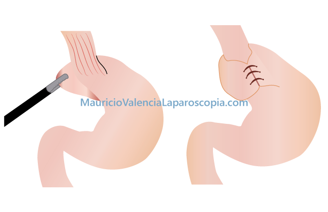 Cirugia antirreflujo por laparoscopia Medellin