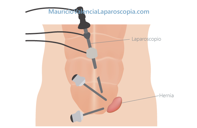 Hernia inguinal por laparoscopia Medellin