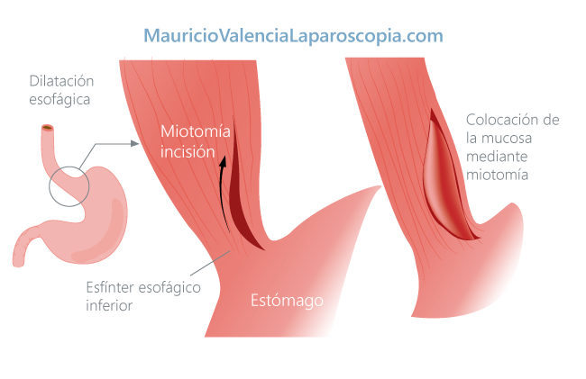 Miotomia de Heller por Laparoscopia Medellin