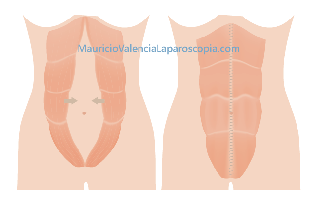 Plicatura de rectos abdominales por laparoscopia Medellin