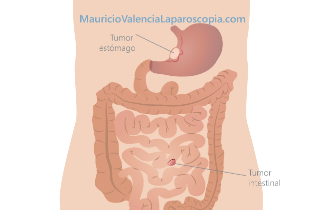 Resecciones de tumores gastrointestinales por laparoscopia Medellin