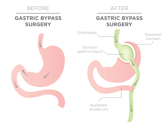 Gastric Bypass