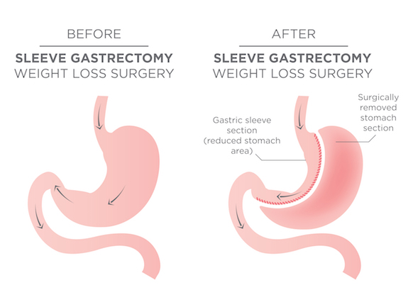Sleeve or Gastric Sleeve