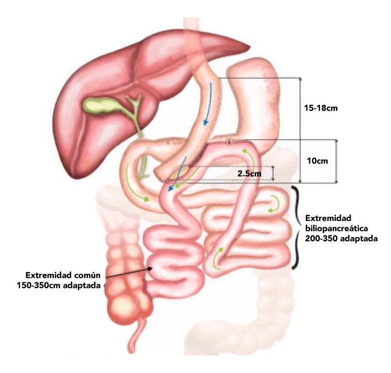 Bypass gastrico de una anastomosis BAGUA