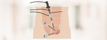 Hernia inguinal