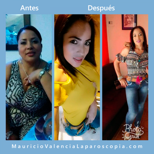 Antes Despues Cirugia De Obesidad Medellin